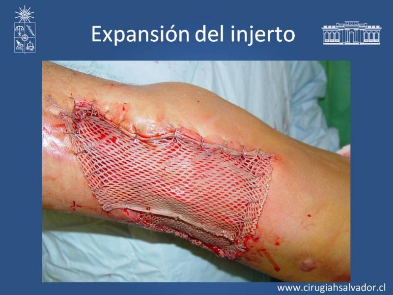 Diapositiva 34 de Injerto dermo-epidérmico: Técnica Quirúrgica 