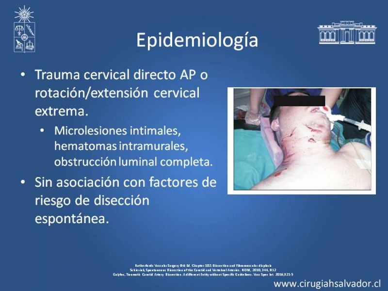 Diapositiva 22 de Disección Carotídea