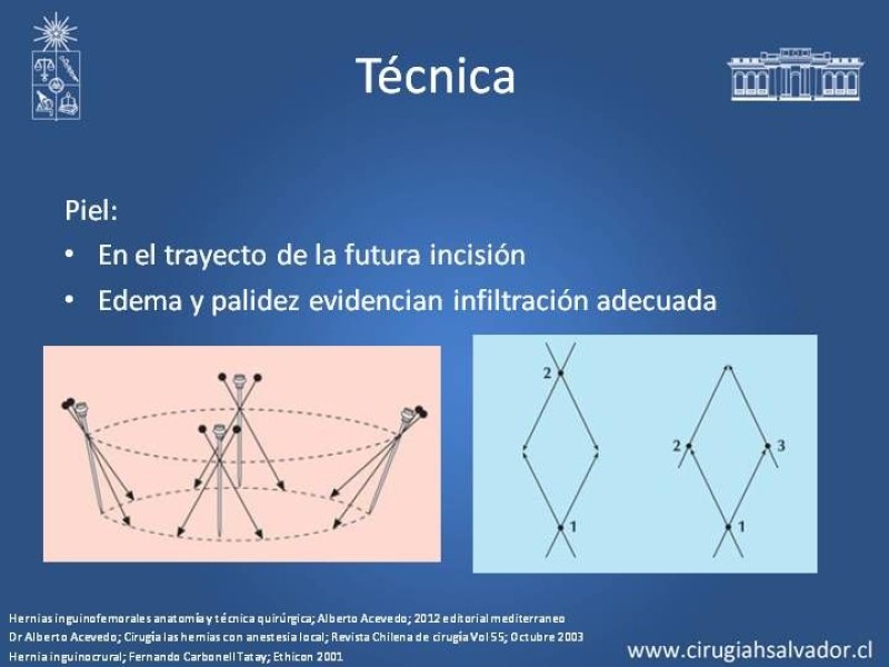 Diapositiva 10 de A. Local en la reparación de hernia Inguinal