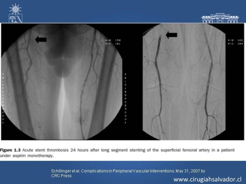 Diapositiva 12 de Complicaciones en Cirugía Endovascular