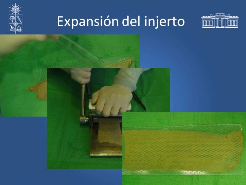 Diapositiva 33 de Injerto dermo-epidérmico: Técnica Quirúrgica 