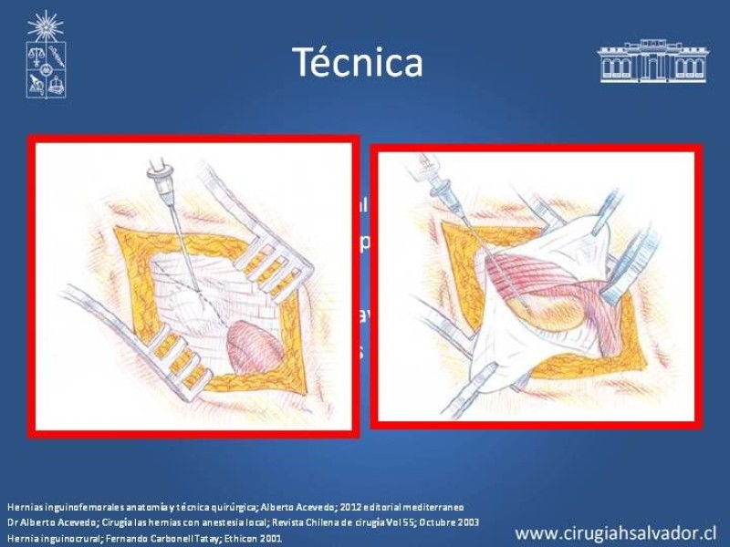 Diapositiva 15 de A. Local en la reparación de hernia Inguinal