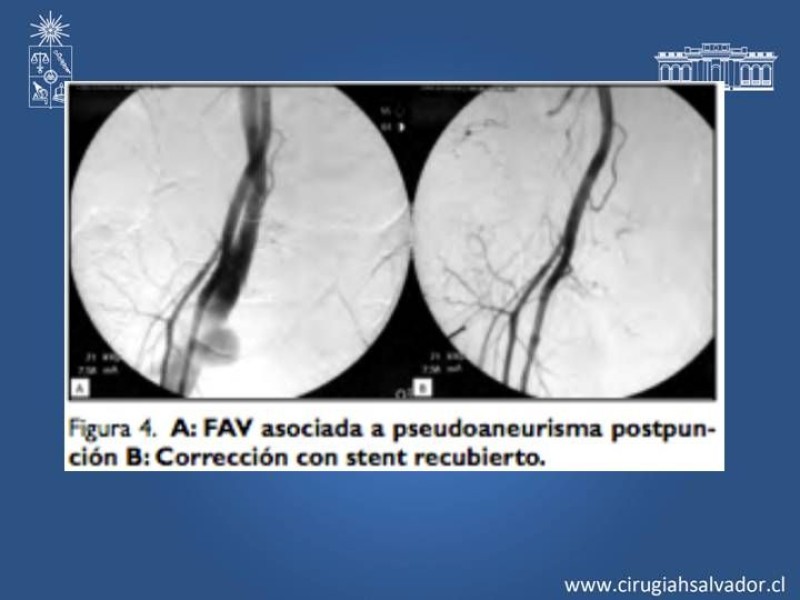 Diapositiva 10 de Complicaciones en Cirugía Endovascular