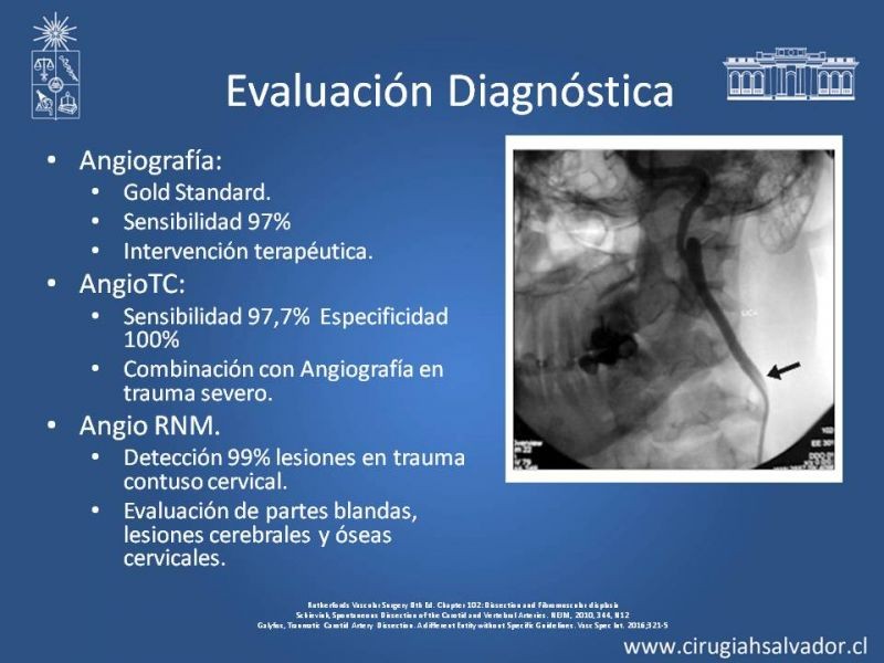 Diapositiva 25 de Disección Carotídea