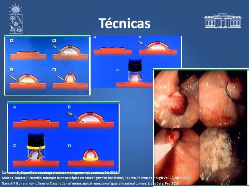 Diapositiva 7 de Resultados Disección Submucosa en esófago y estómago
