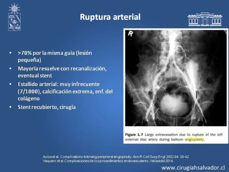 Diapositiva 14 de Complicaciones en Cirugía Endovascular