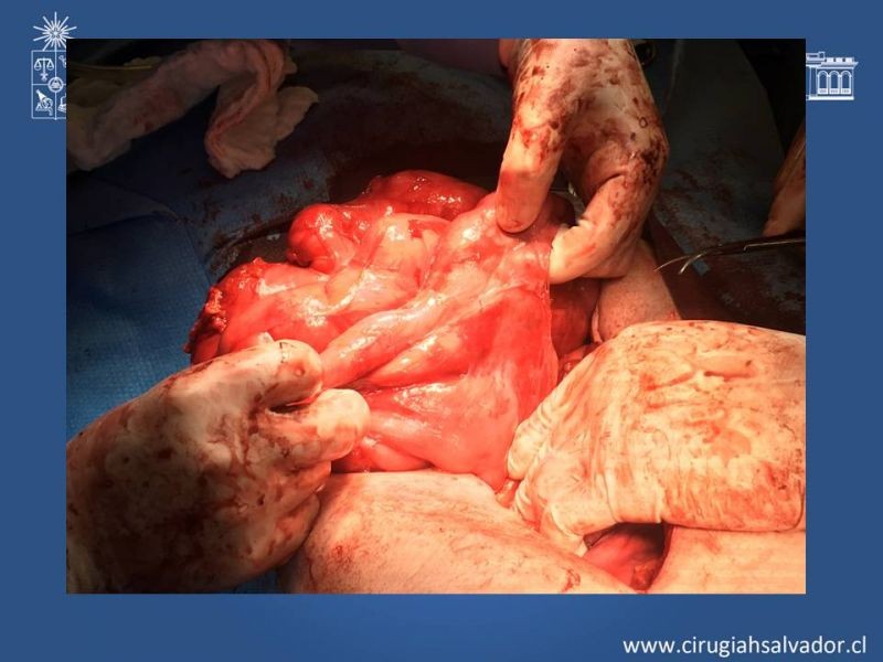 Diapositiva 13 de Peritonitis esclerosante encapsulante (Síndrome Cocoon)