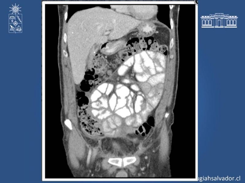 Diapositiva 24 de Peritonitis esclerosante encapsulante (Síndrome Cocoon)