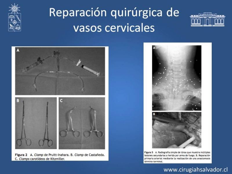 Diapositiva 28 de Trauma Carotídeo