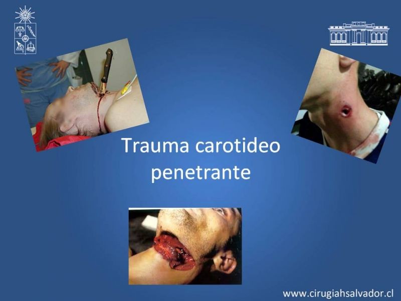 Diapositiva 8 de Trauma Carotídeo