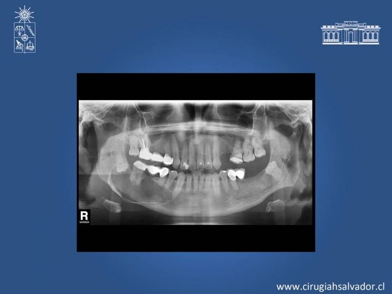 Diapositiva 8 de Ameloblastoma