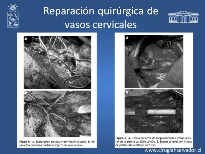 Diapositiva 29 de Trauma Carotídeo