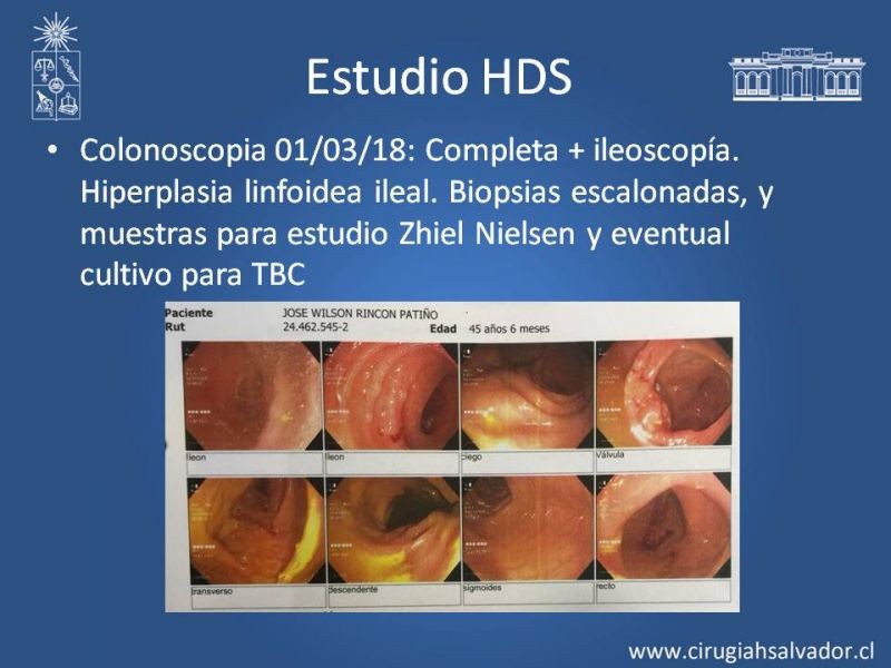 Diapositiva 9 de Peritonitis esclerosante encapsulante (Síndrome Cocoon)