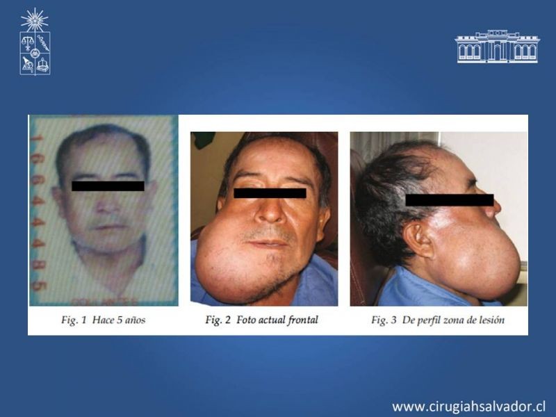 Diapositiva 5 de Ameloblastoma