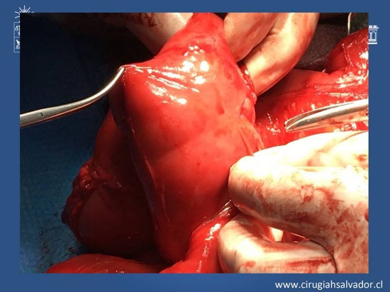Diapositiva 14 de Peritonitis esclerosante encapsulante (Síndrome Cocoon)