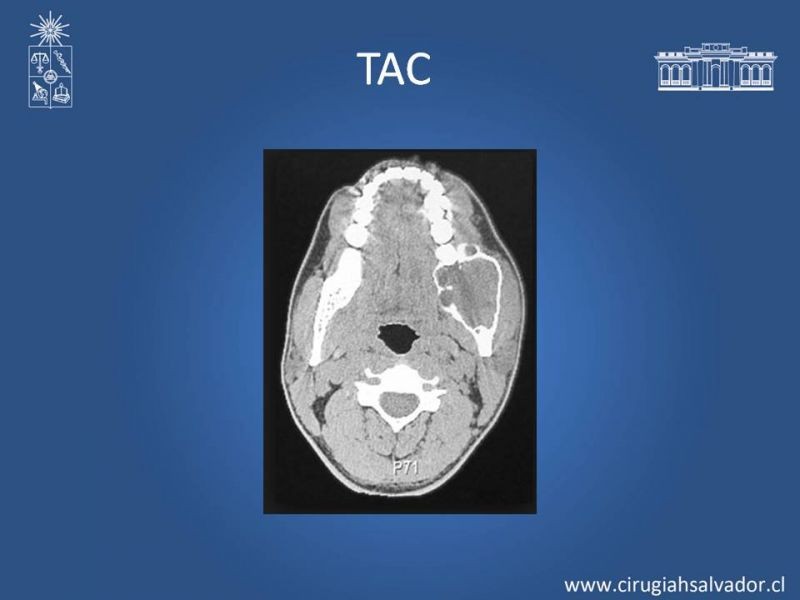 Diapositiva 12 de Ameloblastoma