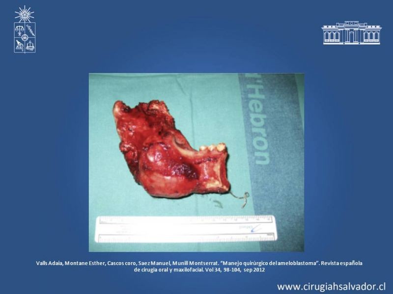 Diapositiva 17 de Ameloblastoma