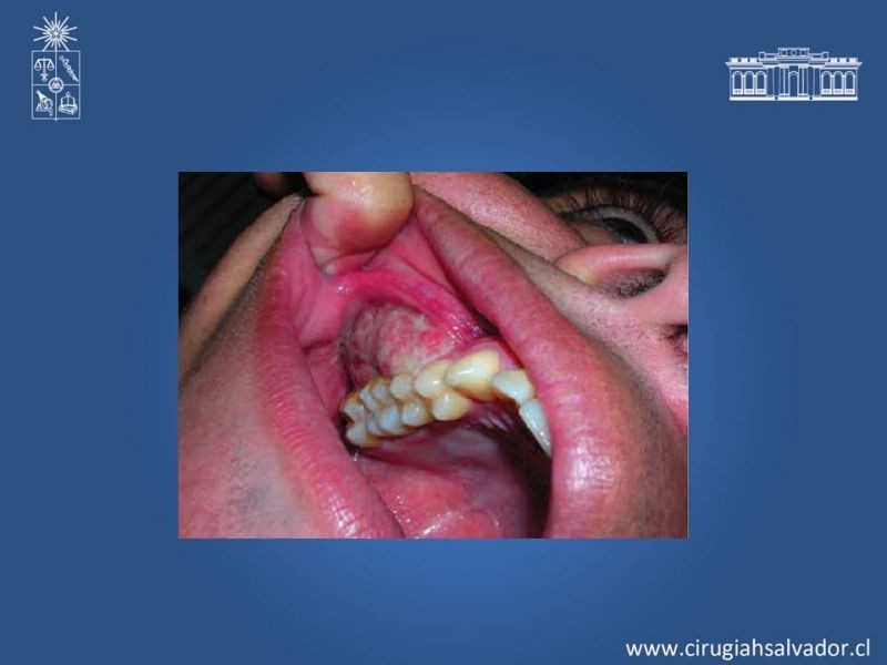 Diapositiva 4 de Ameloblastoma