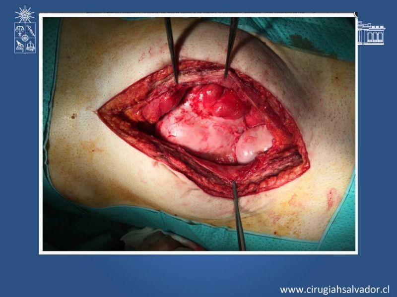 Diapositiva 21 de Peritonitis esclerosante encapsulante (Síndrome Cocoon)