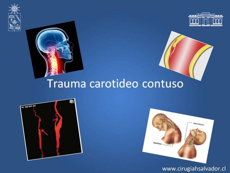 Diapositiva 31 de Trauma Carotídeo