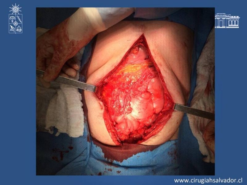 Diapositiva 12 de Peritonitis esclerosante encapsulante (Síndrome Cocoon)