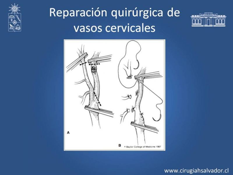 Diapositiva 27 de Trauma Carotídeo