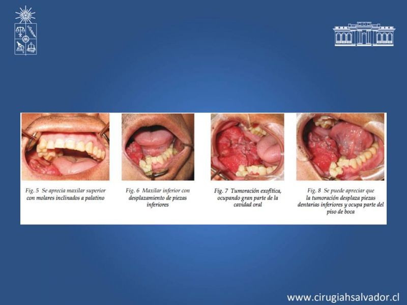 Diapositiva 6 de Ameloblastoma