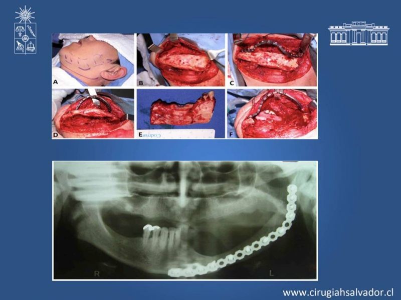 Diapositiva 18 de Ameloblastoma
