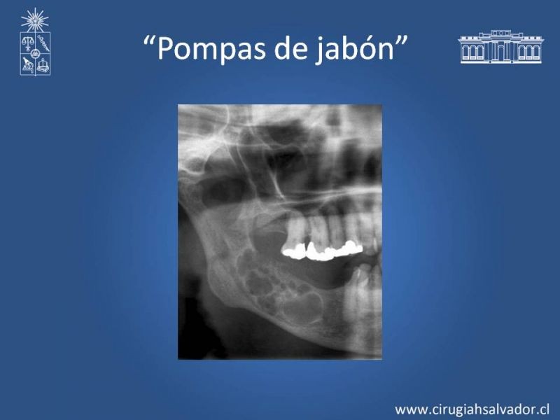 Diapositiva 10 de Ameloblastoma