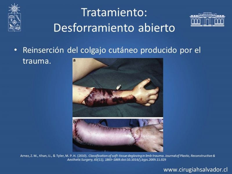 Diapositiva 15 de Desforramiento