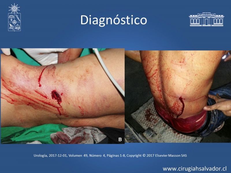 Diapositiva 4 de Trauma Renal