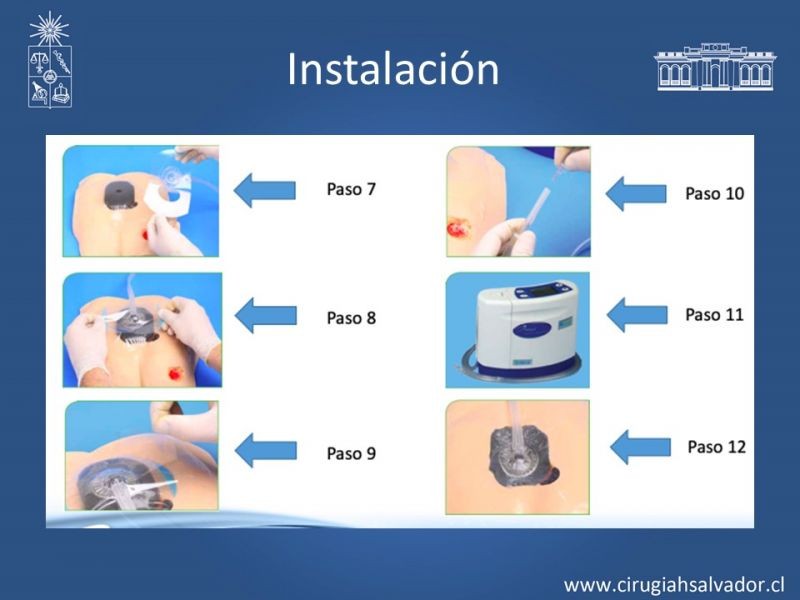 Diapositiva 22 de Terapia de presión negativa