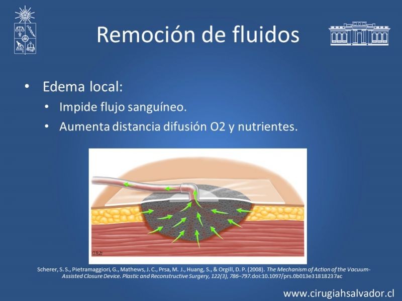 Diapositiva 8 de Terapia de presión negativa