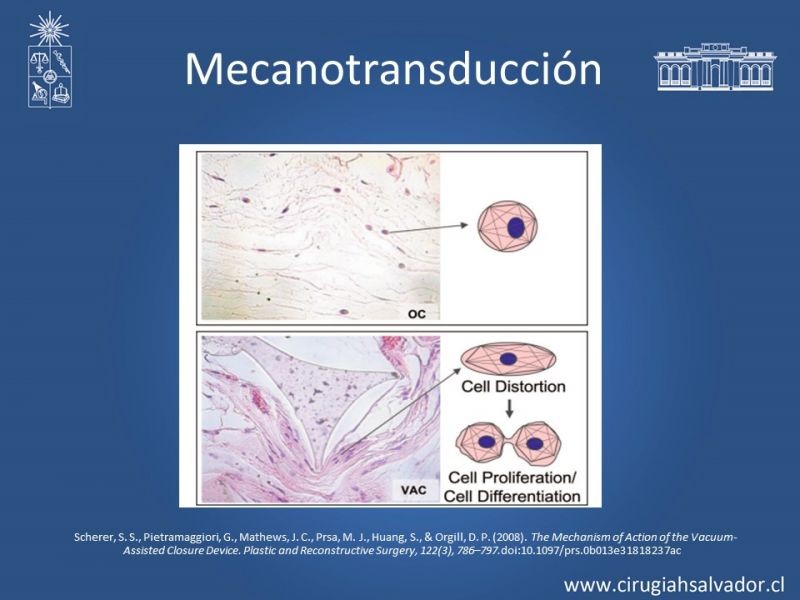 Diapositiva 10 de Terapia de presión negativa