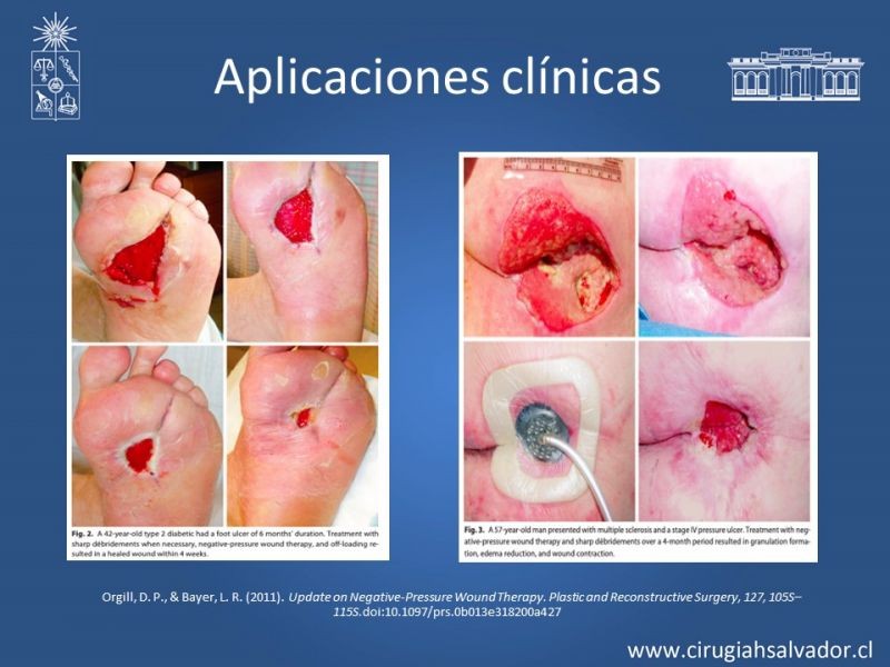 Diapositiva 23 de Terapia de presión negativa