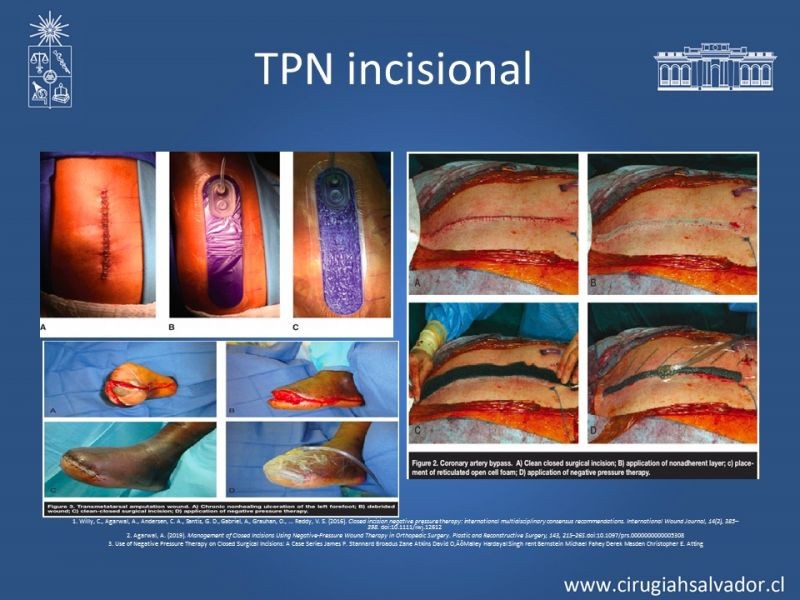 Diapositiva 24 de Terapia de presión negativa