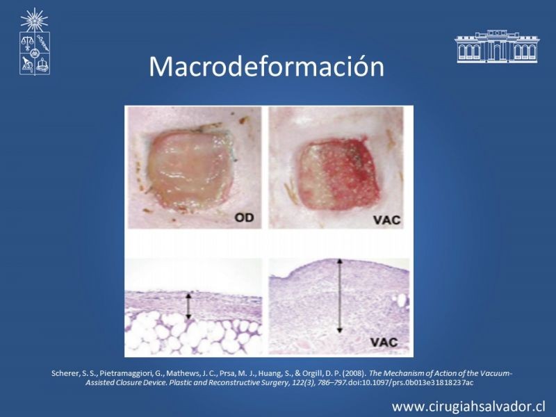 Diapositiva 11 de Terapia de presión negativa