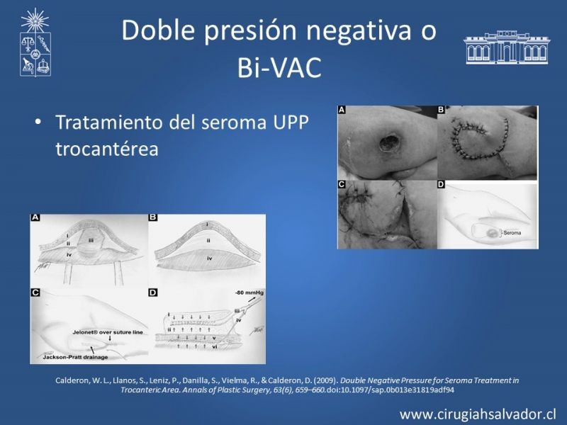 Diapositiva 26 de Terapia de presión negativa