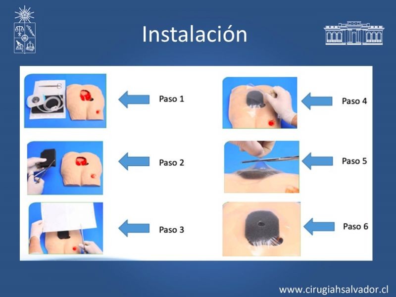 Diapositiva 21 de Terapia de presión negativa