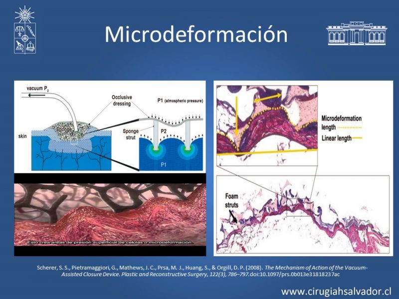 Diapositiva 9 de Terapia de presión negativa