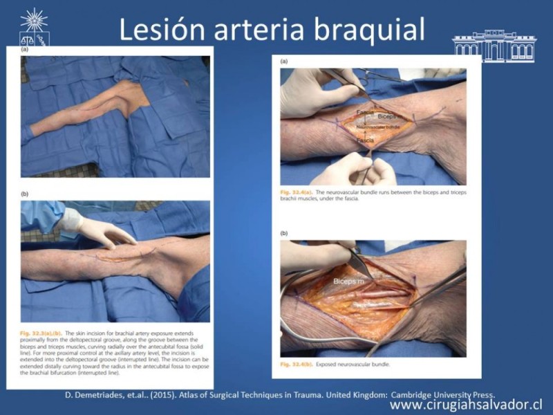 Diapositiva 26 de Trauma Vascular Periférico