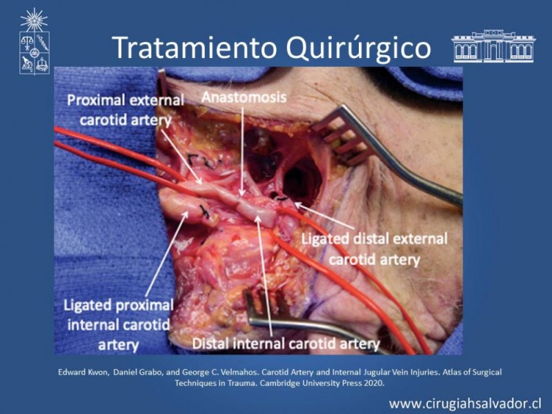 Diapositiva 38 de Trauma Carotídeo