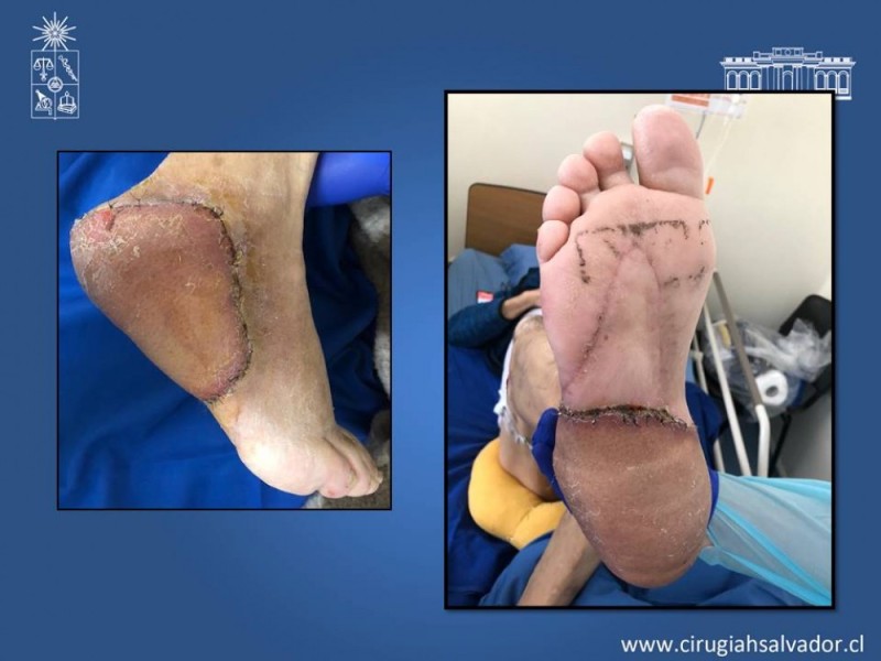 Diapositiva 56 de Aplicación Colgajos Perforantes