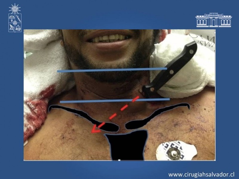 Diapositiva 10 de Trauma Carotídeo
