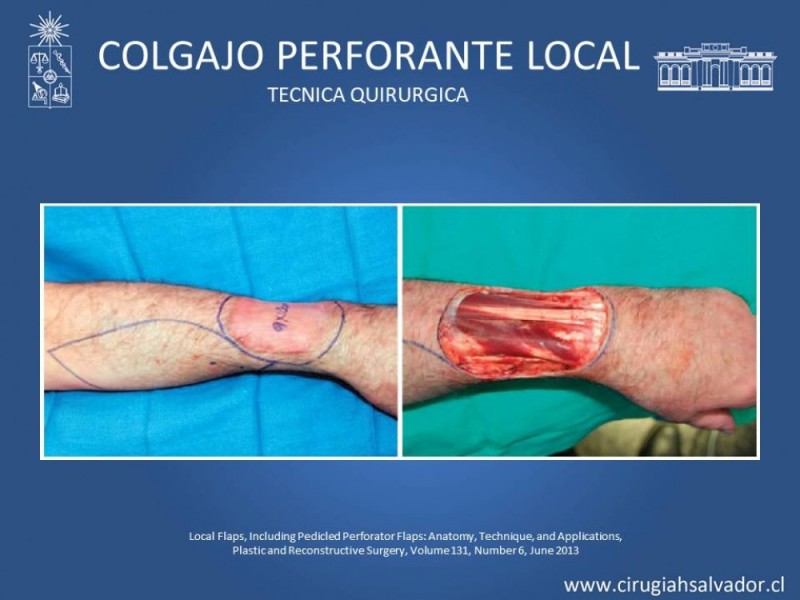 Diapositiva 16 de Aplicación Colgajos Perforantes