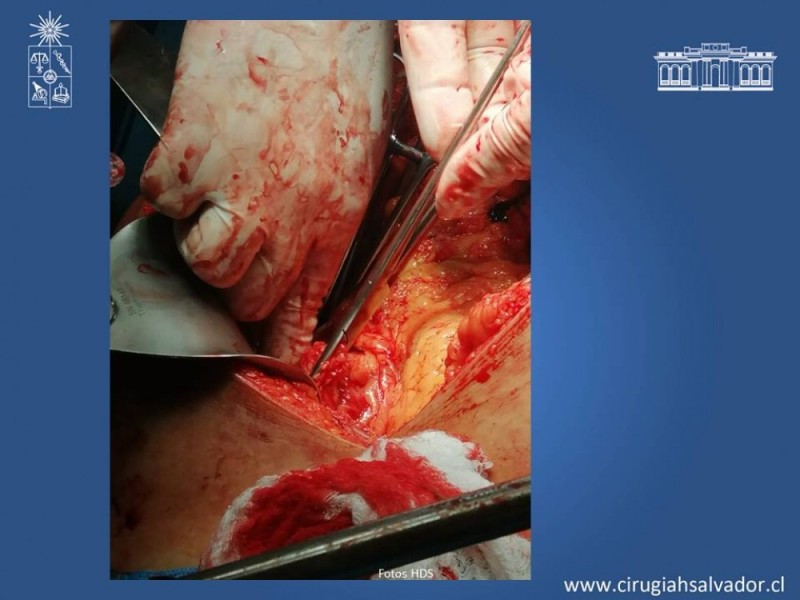 Diapositiva 29 de Trauma Esplénico