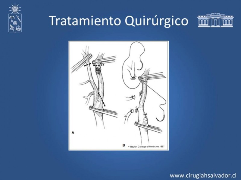 Diapositiva 45 de Trauma Carotídeo
