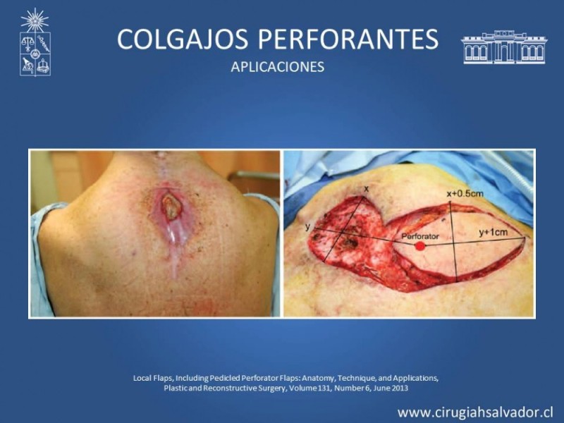 Diapositiva 46 de Aplicación Colgajos Perforantes
