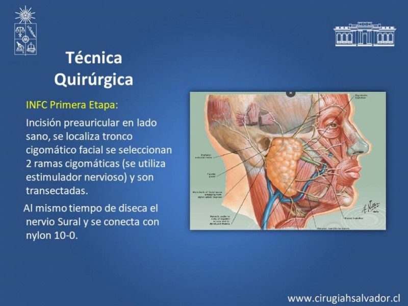 Diapositiva 6 de Injerto Nervioso facial vs transposición Nervio Masetérico