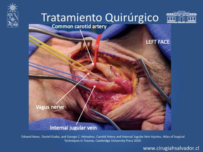 Diapositiva 35 de Trauma Carotídeo
